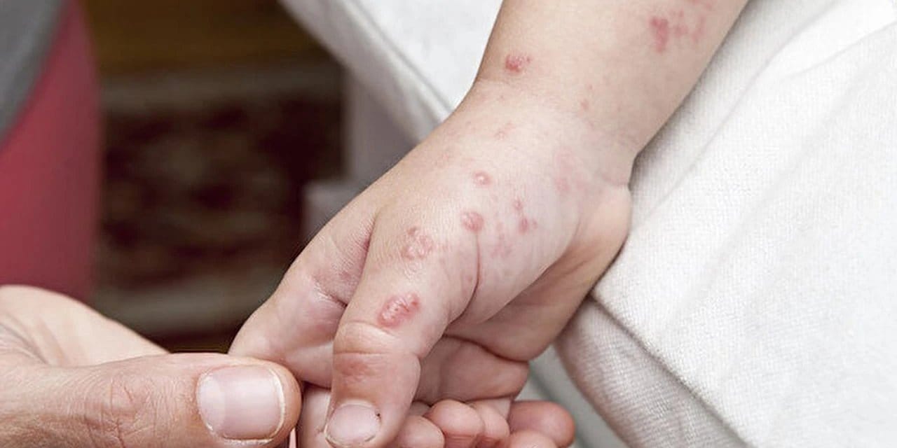 İngiltere alarma geçti: Maymun Çiçeği’nin yeni varyantı ortaya çıktı